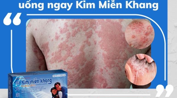 Tìm hiểu bệnh vảy nến đỏ da toàn thân và giải pháp từ Kim Miễn Khang