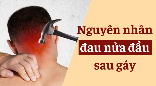 Nguyên nhân đau nửa đầu sau gáy và cách giảm đau hiệu quả với Bách Thống Vương