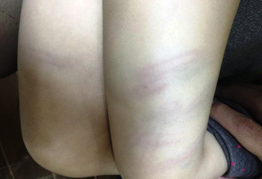 Thanh Hóa: Bé 3 tuổi bị cô giáo mầm non dùng đũa đánh thâm tím đùi - Hình 1