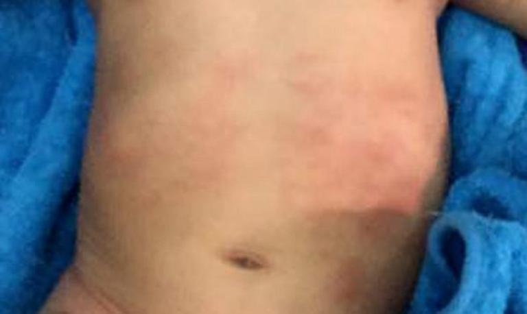 Mùa hè cần lưu ý bệnh nhiễm trùng huyết từ rôm sảy, mẩn ngứa của trẻ nhỏ