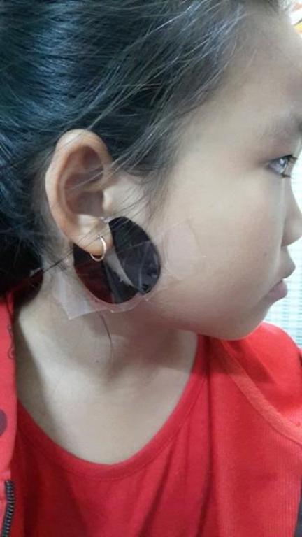 Cẩn trọng khi dùng cao dán trị quai bị