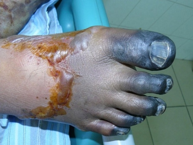 Thừa Thiên Huế: Một nam thanh niên tử vong nghi nhiễm cầu lợn - Hình 1