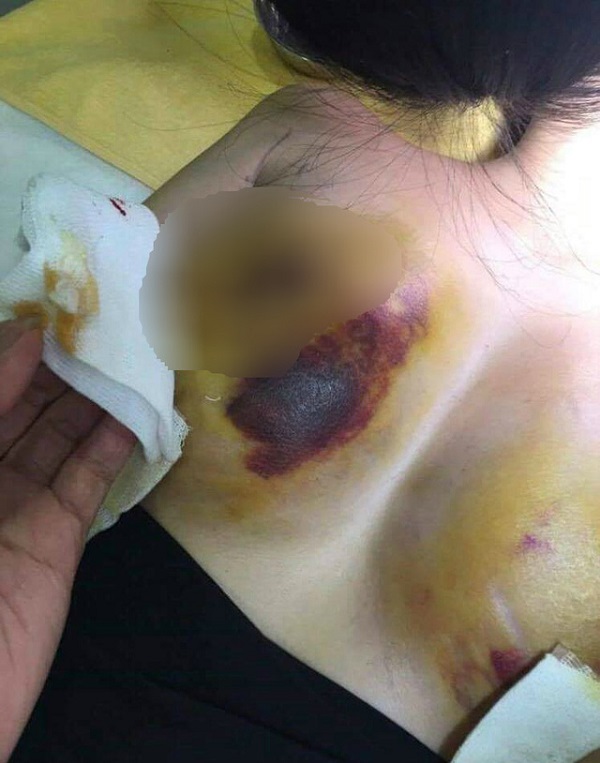 Bộ Y tế yêu cầu làm rõ vụ nâng ngực bị biến chứng tại TMV Kim Cương A&B