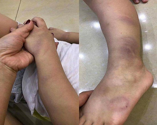 Hải Dương: Buộc thôi việc đối với giáo viên đánh học sinh 3 tuổi tím tay