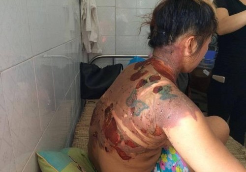 Thanh Hóa: Khởi tố vụ án chồng dội nước sôi lên người vợ trẻ