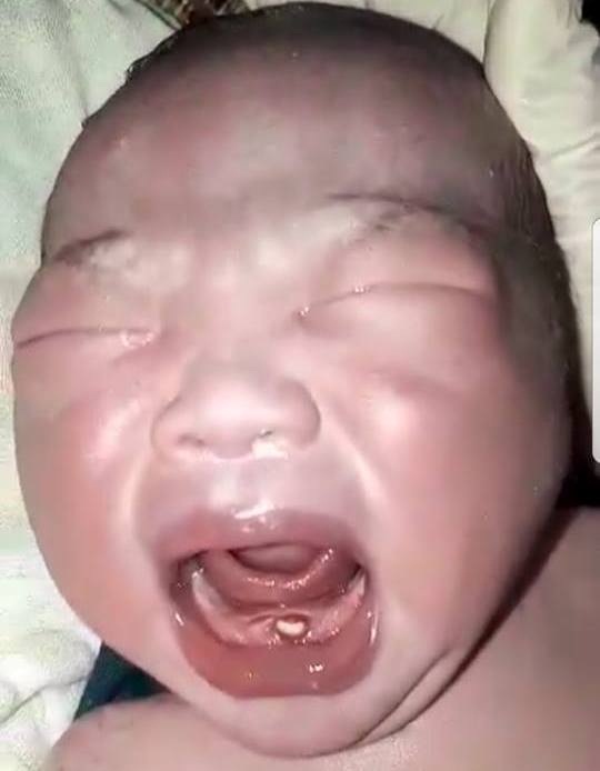 Hà Tĩnh: Kỳ lạ bé trai vừa sinh đã có răng ở hàm dưới - Hình 1