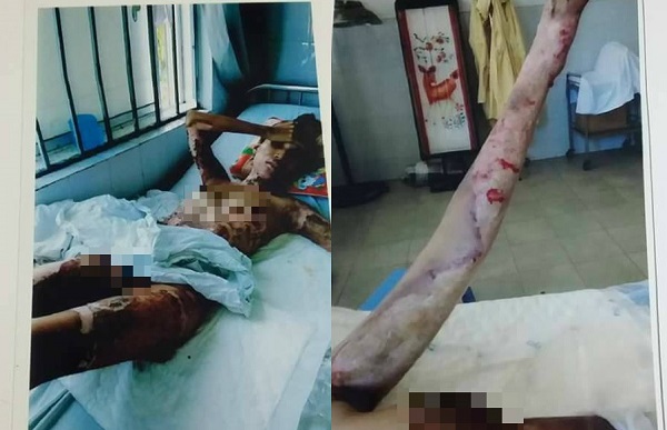 Quảng Nam: Cảm thương người vợ trẻ bị chồng dùng xăng thiêu sống