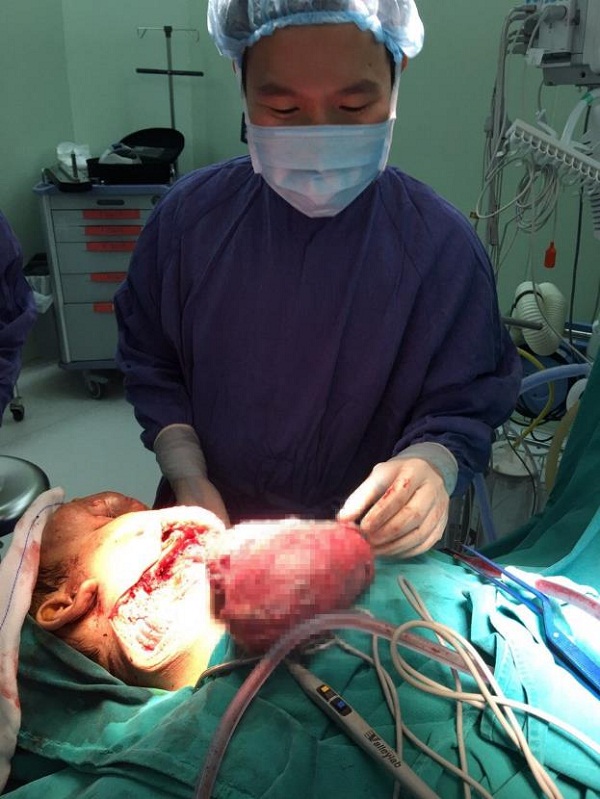 Ca mổ kỷ lục lấy lại gương mặt cho bệnh nhân mắc khối u khủng