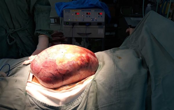 BV TƯ Huế: Phẩu thuật thành công khối u buồng trứng khổng lồ trong bụng cô gái trẻ - Hình 1