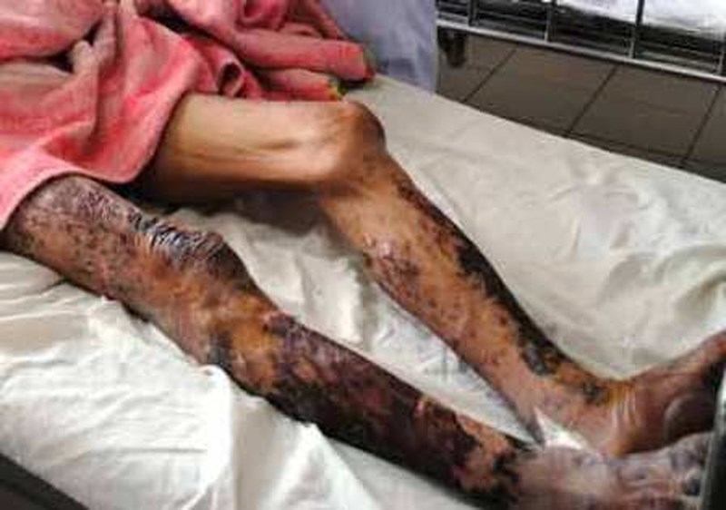 Ăn nem chua, tiết canh, thịt sống có nguy cơ nhiễm liên cầu khuẩn lợn