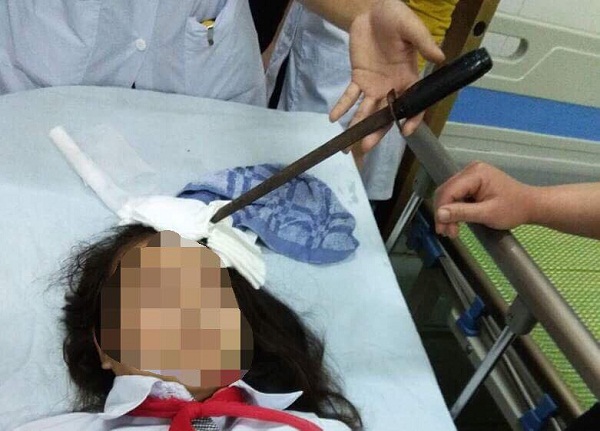 Hà Nam: Nữ sinh bị bạn học phi dao cắm thẳng trán - Hình 1