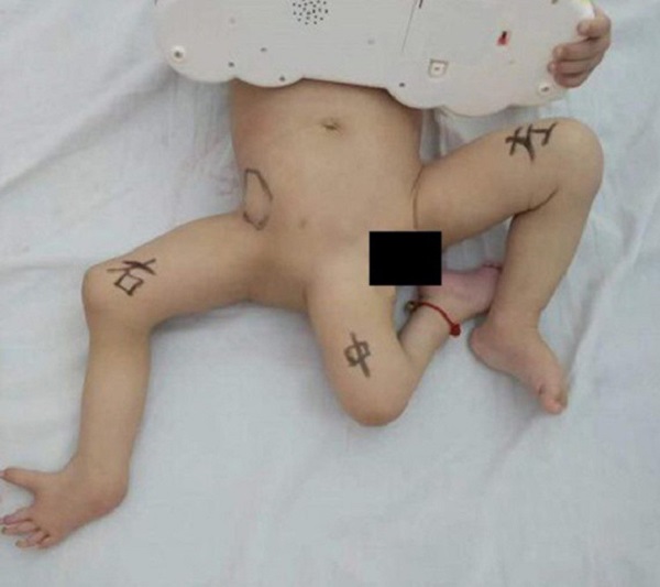 Em bé 3 chân ra đời ở Trung Quốc - Hình 1