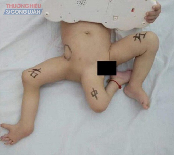 Em bé 3 chân ra đời ở Trung Quốc