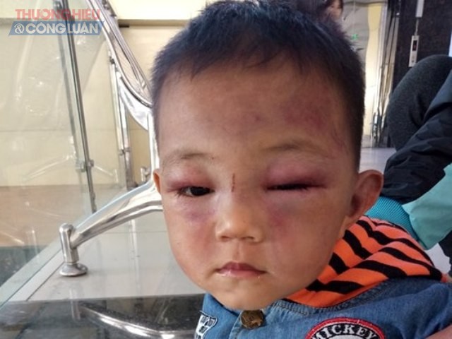 Nghệ An: Bé trai 2 tuổi bị cha dượng đánh thương tích - Hình 1