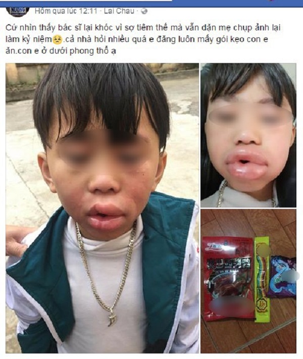 Nghi vấn: Học sinh bị sưng môi vì ăn kẹo tại cổng trường