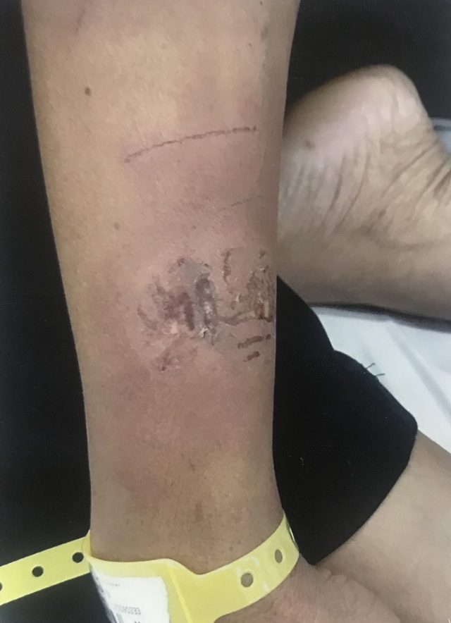 Luật sư nói gì về vụ: “Phó công an xã vô cớ bắt, đánh dân chấn thương sọ não”?