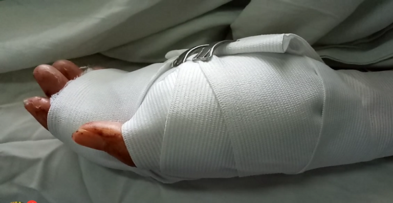 Đà Nẵng: Ngang nhiên cầm vũ khí chém người đứt lìa bàn tay