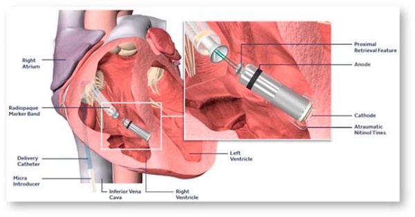Lần đầu tiên đặt thành công máy tạo nhịp tim không dây - Hình 2