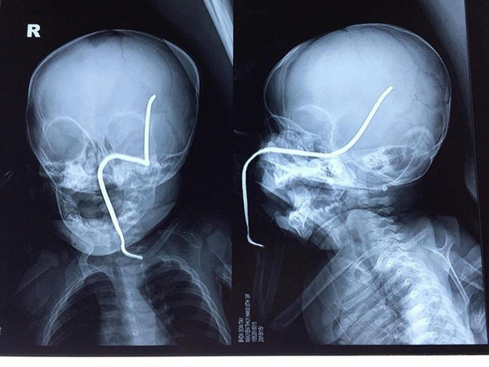 Bị thanh sắt xuyên thủng sọ, bé 8 tháng tuổi thoát chết thần kỳ - Hình 1