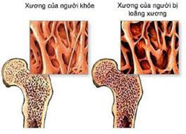 Thuốc ngừa loãng xương và những rủi do khi dùng
