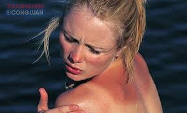 Cách khắc phục da bị cháy nắng - Hình 1