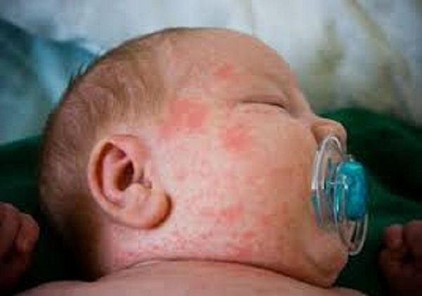 Những bệnh ngoài da thường gặp ở trẻ vào mùa hè