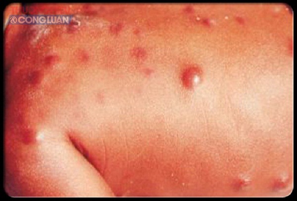 Những bệnh ngoài da thường gặp ở trẻ vào mùa hè - Hình 3
