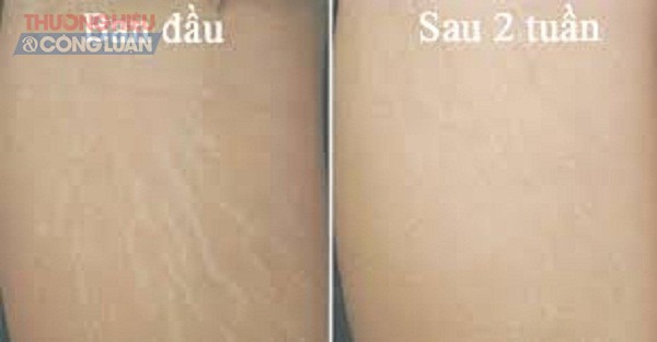 Cách chữa rạn da với nghệ tươi - Hình 1