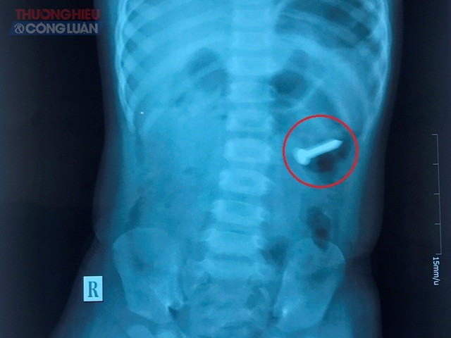 Nghệ An: Gắp đinh ốc xoắn trong ruột bé 2 tuổi - Hình 1