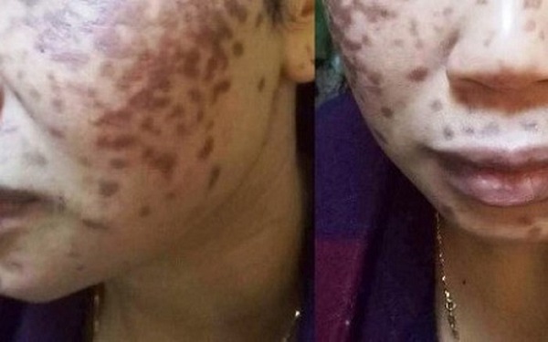 Bị bỏng toàn bộ da mặt khi đến Spa trị nám bằng chấm a xít theo quảng cáo