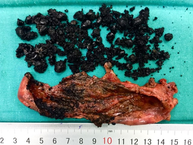 Nguy cơ hoại tử túi mật do viêm túi mật cấp