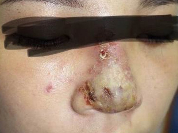 Một phụ nữ méo mặt, mũi bọc mủ vì tiêm chất làm đầy