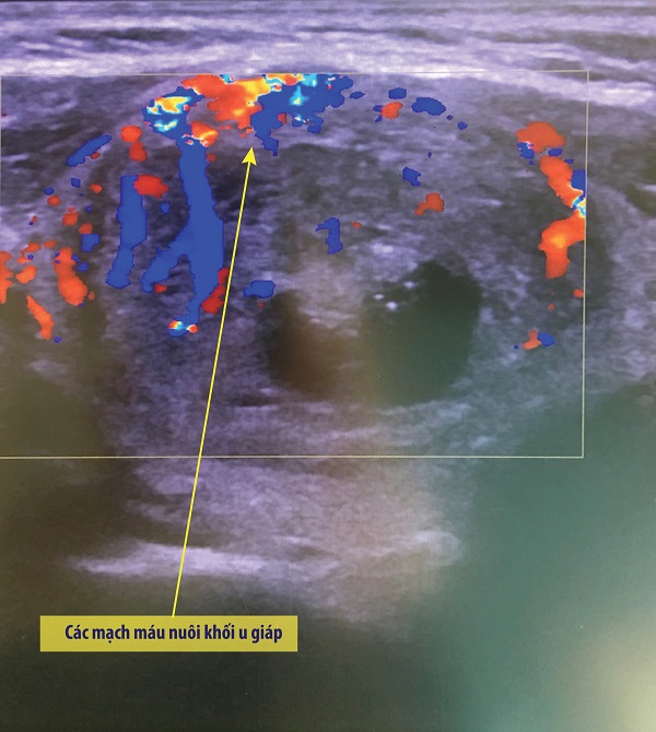 Nhẹ nhàng loại bỏ u tuyến giáp, không cần mổ