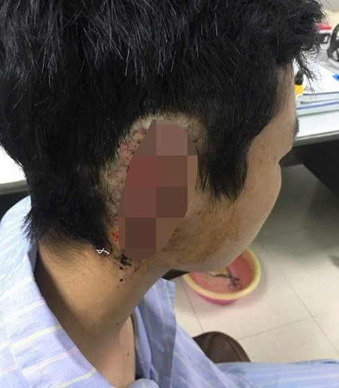 Nghệ An: Nam sinh cắn đứt tai bạn cùng trường nghi bị 