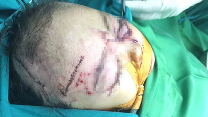 Nghệ An: Bị chó nhà cắn, bé gái 31 tháng tuổi thương tích nặng