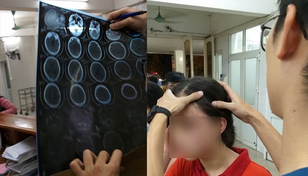 Hà Nội: Con gái 14 tuổi cầu cứu mẹ đẻ vì bị mẹ kế đánh rạn đầu - Hình 1