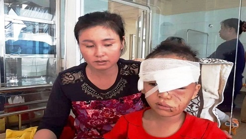 Thanh Hóa: Bé trai nhập viện khi bị chính chó nhà nuôi tấn công rách mặt - Hình 1