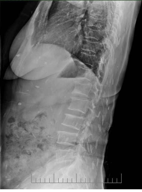 Nhập viện điều trị đau thắt lưng, phát hiện sán lá gan sinh sôi khắp người - Hình 1