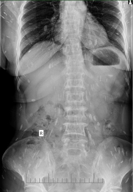 Nhập viện điều trị đau thắt lưng, phát hiện sán lá gan sinh sôi khắp người