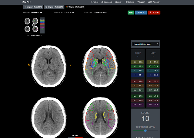 Bệnh viện Đa khoa Phú Thọ: Tiên phong phần mềm Rapid trong điều trị đột quỵ