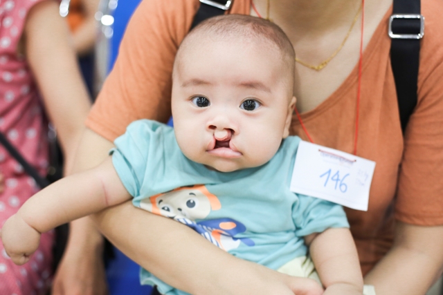 Hàng trăm trẻ được phẩu thuật nụ cười miễn phí