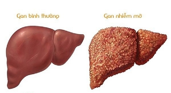 Nguy cơ bị gan nhiễm mỡ từ 6 loại thực phẩm