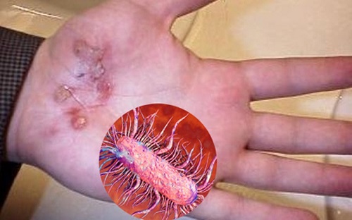 Cách phòng tránh vi khuẩn ăn thịt người