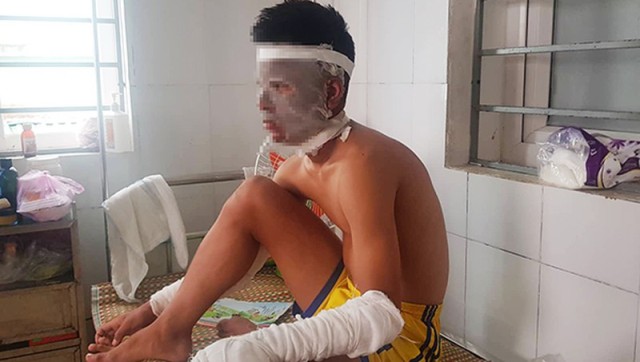 Nổ chùm bóng bay chứa khí hidro, 3 cầu thủ trẻ Sông Lam Nghệ An nhập viện vì bỏng nặng