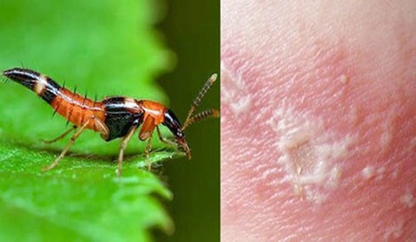 Nọc độc có kiến ba khoang mạnh gấp 12-15 lần nọc rắn hổ mang