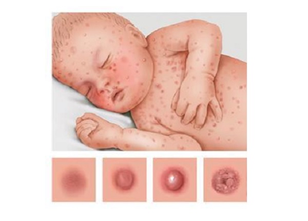 Xử lý các bệnh ngoài da do virus thường gặp như thế nào?