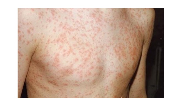 Xử lý các bệnh ngoài da do virus thường gặp như thế nào?