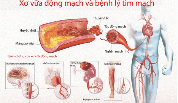 Máu nhiễm mỡ: Nguyên nhân, dấu hiệu và giải pháp hỗ trợ tốt cho bệnh