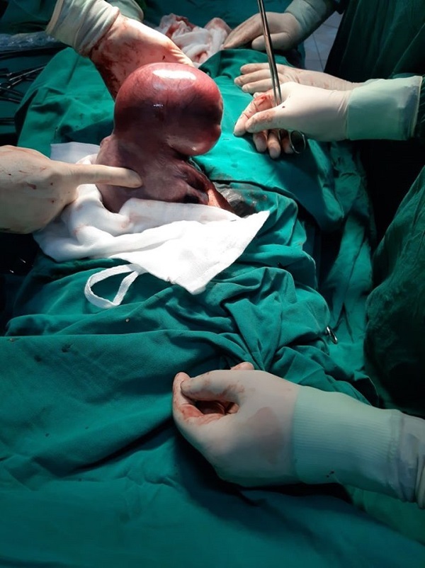 Bệnh viện phụ sản Hải Phòng mổ đẻ kết hợp bóc tách thành công khối u xơ tử cung