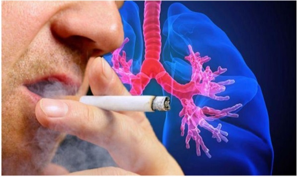 Khói thuốc lá là kẻ thù số một của bệnh u phổi
